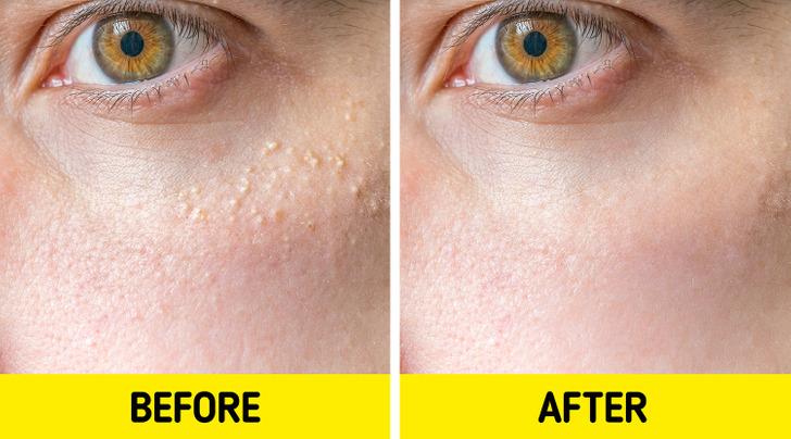 μικρά-λευκά σπυράκια-στο-πρόσωπο-και-πως-αντιμετωπίζονται-