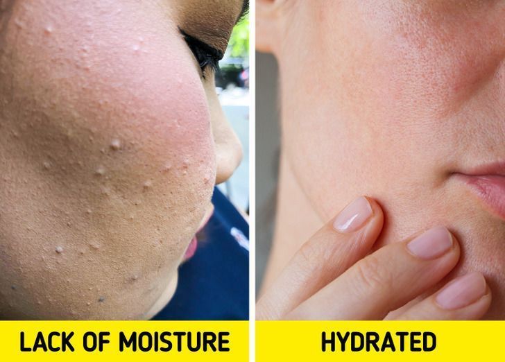 μικρά-λευκά σπυράκια-στο-πρόσωπο-και-πως-αντιμετωπίζονται-