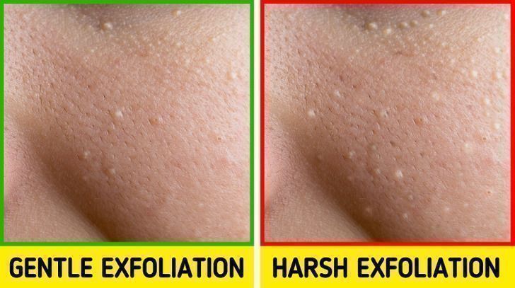 μικρά-λευκά σπυράκια-στο-πρόσωπο-και-πως-αντιμετωπίζονται-