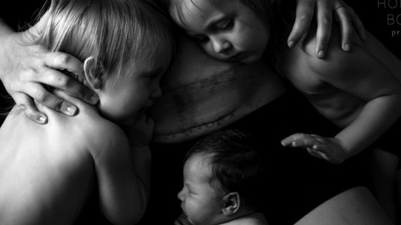 Καισαρική: Οι συγκλονιστικές φωτογραφίες που δείχνουν το σώμα μετά την καισαρική