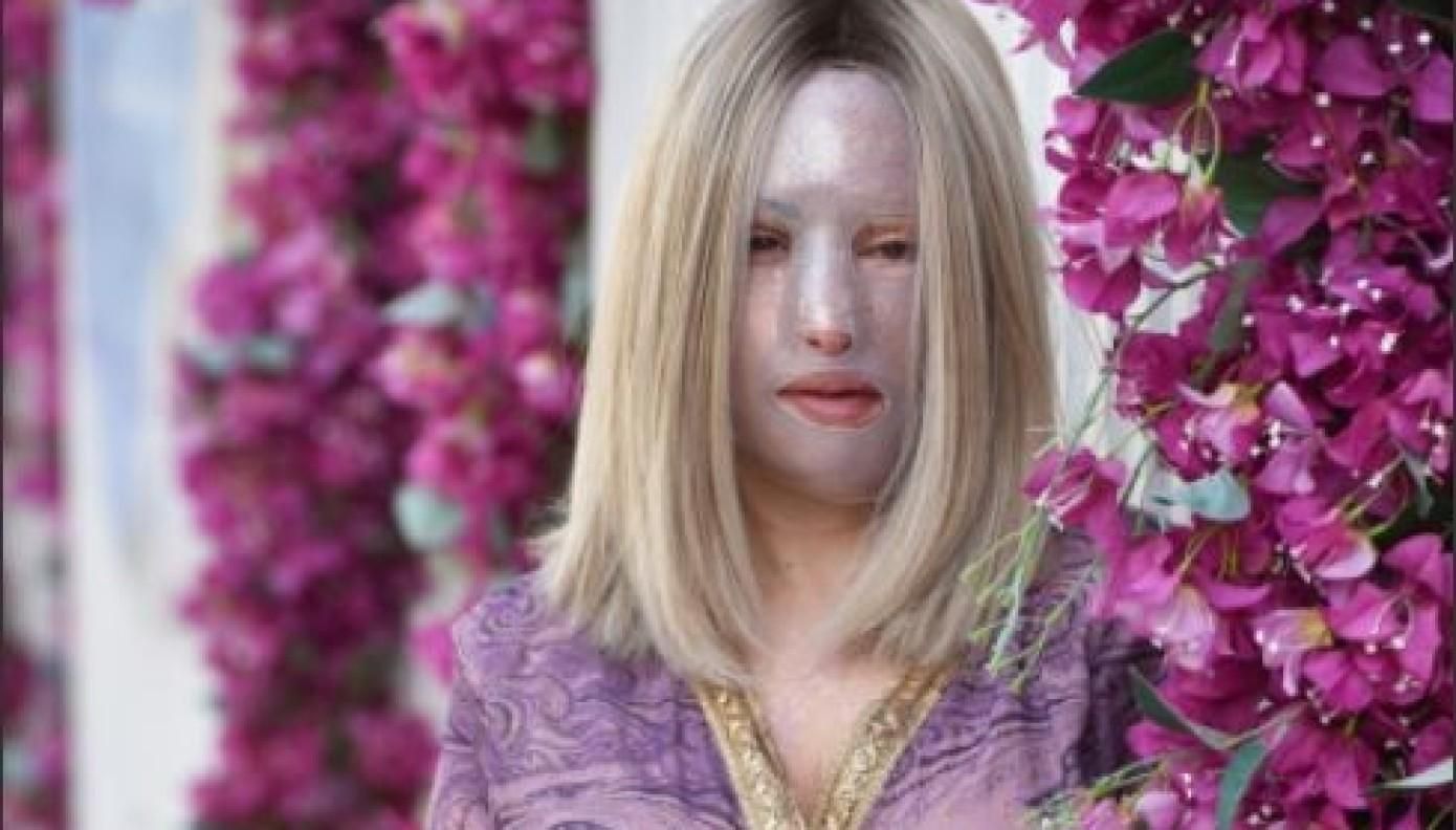 Ιωάννα Παλιοσπύρου: Δείχνει το πρόσωπο της και περιγράφει τις σοκαριστικές στιγμές της επίθεσης με το βιτριόλι