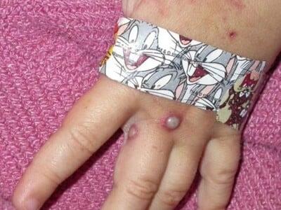 ΕΟΔΥ για ΕΥΛΟΓΙΑ: Αυτά είναι τα συμπτώματα-Δεν έχει θεραπεία