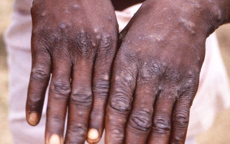 ΕΟΔΥ για ΕΥΛΟΓΙΑ: Αυτά είναι τα συμπτώματα-Δεν έχει θεραπεία