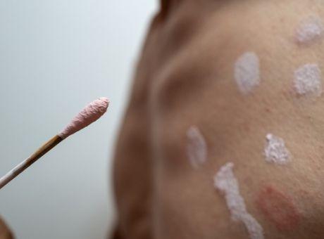 ΕΟΔΥ για ΕΥΛΟΓΙΑ: Αυτά είναι τα συμπτώματα-Δεν έχει θεραπεία