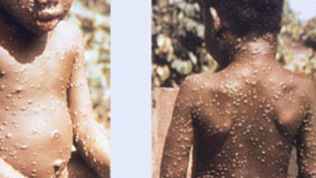 ΕΟΔΥ για ΕΥΛΟΓΙΑ: Αυτά είναι τα συμπτώματα-Δεν έχει θεραπεία