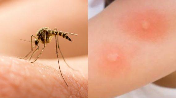γιατί-τα-κουνούπια-τσιμπούν-εσάς-