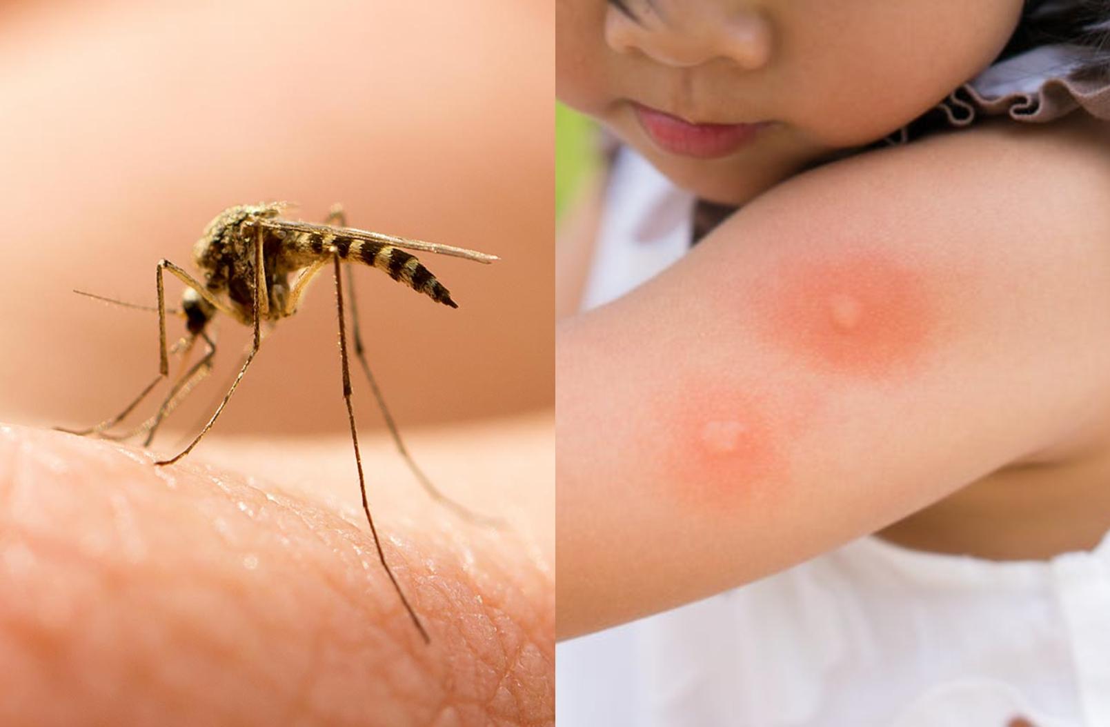 Τσίμπημα κουνουπιών: Αυτή την βιταμίνη χρειαζόμαστε για να μην μας τσιμπάνε