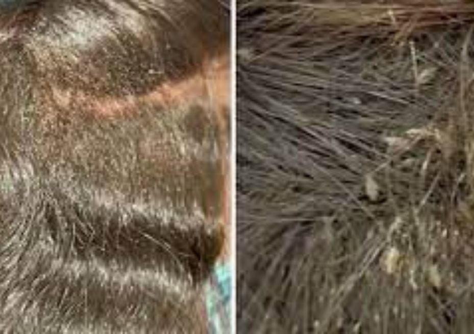 ΣΟΚ: Νεκρό 9χρονο παιδί απο τις ψείρες – Συνελήφθησαν μητέρα και γιαγιά