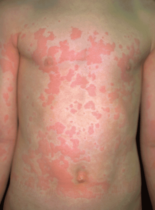 αλλεργία-στον-ήλιο-συμπτώματα-θεραπεία-