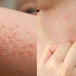 Αλλεργία στον ήλιο: Τι είναι, ποια είναι τα συμπτώματα και πως να προστατευθείς