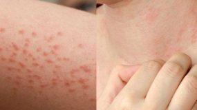 Αλλεργία στον ήλιο: Τι είναι, ποια είναι τα συμπτώματα και πως να προστατευθείς