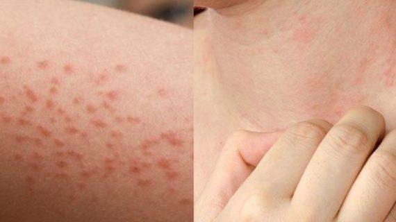 Αλλεργία στον ήλιο: Τι είναι, ποια είναι τα συμπτώματα και πως να προστατευθείς