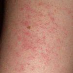 Σπιτική κρέμα ομορφιάς για τα σπυράκια μετά το ξύρισμα