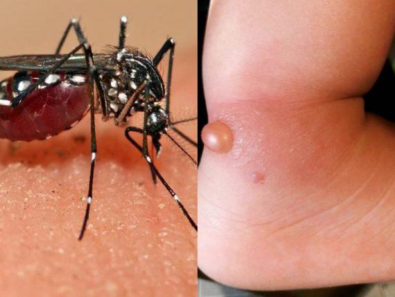 τσίμπημα-από-κουνούπι τίγρη-