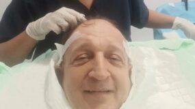Ο Σπύρος Μπιμπίλας έκανε μεταμόσχευση μαλλιών! (εικόνες)