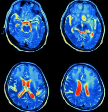 Αμοιβάδα του έφαγε τον εγκέφαλο – Τι είναι η νεγλαιρίαση που τον σκότωσε