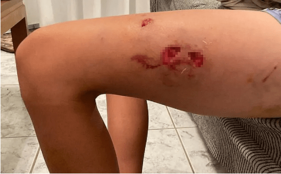 Επίθεση από αγέλη 15 σκυλιών: Πατέρας πάλεψε για να σώσει τα παιδιά του