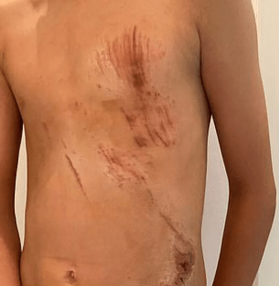 Επίθεση από αγέλη 15 σκυλιών: Πατέρας πάλεψε για να σώσει τα παιδιά του