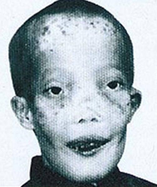 Ρόι Ντένις: H απίστευτη ιστορία ζωής του παιδιού που αντιμετωπιζόταν ως τέρας λόγω της ασθένειας του