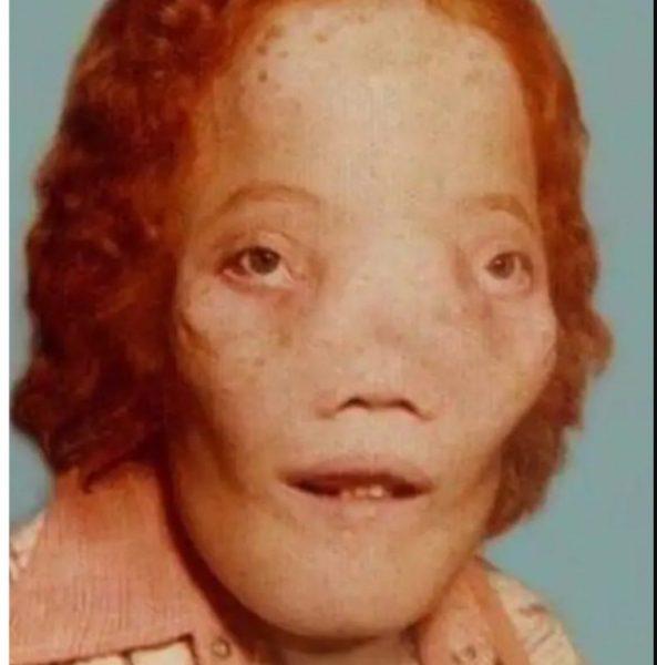 Ρόι Ντένις: H απίστευτη ιστορία ζωής του παιδιού που αντιμετωπιζόταν ως τέρας λόγω της ασθένειας του