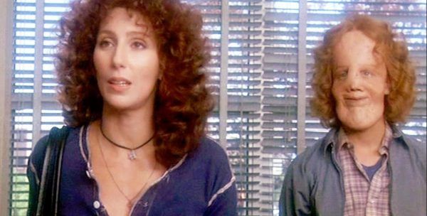 Ρόι Ντένις: H απίστευτη ιστορία ζωής του παιδιού που αντιμετωπιζόταν ως τέρας λόγω της ασθένειας του