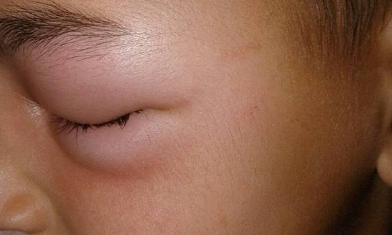 Έκτακτη ανακοίνωση ΕΟΔΥ : Σε έξαρση τα μολυσμένα κουνούπια στην Ελλάδα – Ποιοι θα πρέπει να προσέχουν ιδιαιτέρως