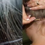 Ψείρες και κόνιδες: 10 κόλπα για να τις εξοντώσετε άμεσα