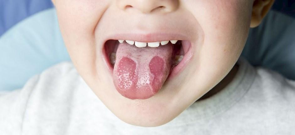 Αφθώδης στοματίτιδα-στα-παιδιά-συμπτώματα-αντιμετώπιση-