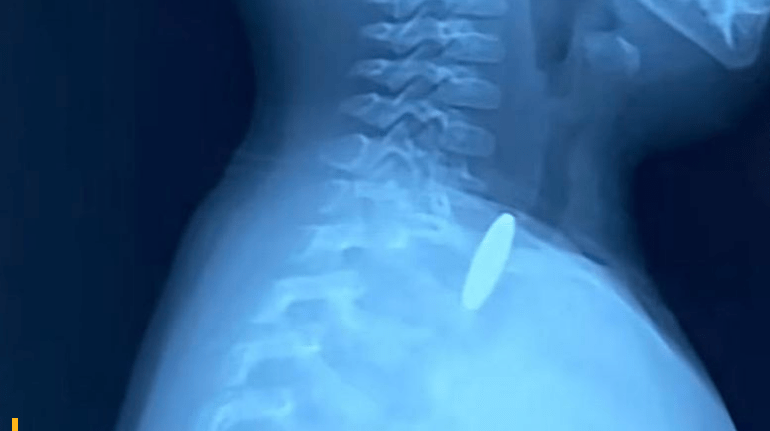 παιδί-κατάπιε κέρμα-και-παραλίγο-να-πεθάνει- παιδί-κατάπιε κέρμα-και-παραλίγο-να-πεθάνει-