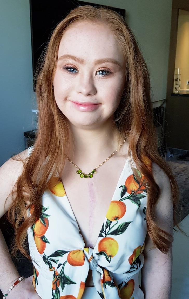 Madeline Stuart-η-ιστορία-για-το-μοντέλο-με-σύνδρομο down-και-αυτισμό- Madeline Stuart-η-ιστορία-για-το-μοντέλο-με-σύνδρομο down-και-αυτισμό-