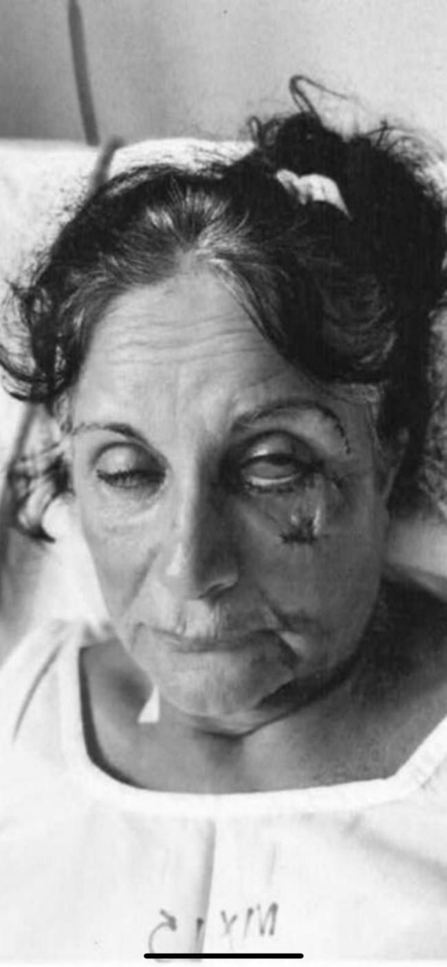 Αίγινα: Κόντεψαν να σκοτώσουν στο ξύλο την 67χρονη επιχειρηματία για 700 ευρώ