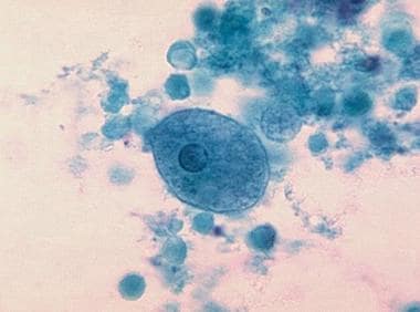 Παράσιτα στο σώμα: Τα συμπτώματα για να τα αναγνωρίσετε και ένα φυσικό αντιπαρασιτικό για να τα διώξετε