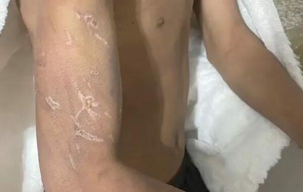 Φρίκη : Μάνα έδενε τα παιδιά και τους έριχνε χλωρίνη στα γεννητικά τους όργανα και στον λαιμό τους μέχρι να τους κάψει το δέρμα