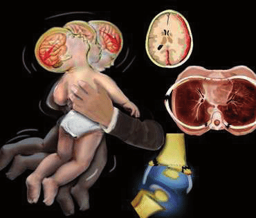 Σύνδρομο ανατάραξης μωρού: Τι είναι, τα συμπτώματα και οι σοβαρές βλάβες