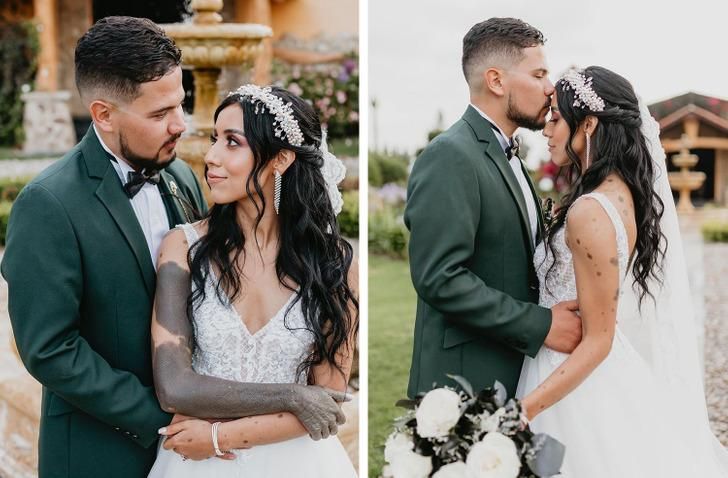 Libny Molano-σημάδια-εκ γενετής-