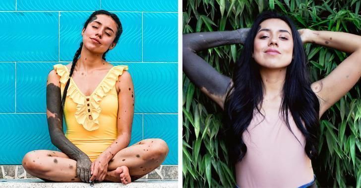 Libny Molano-σημάδια-εκ γενετής-