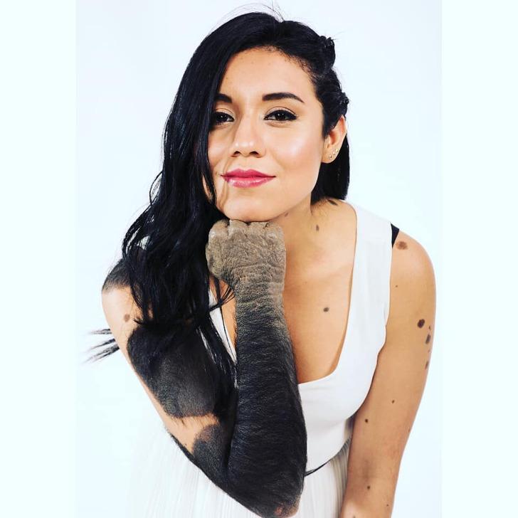 Libny Molano-σημάδια-εκ γενετής-