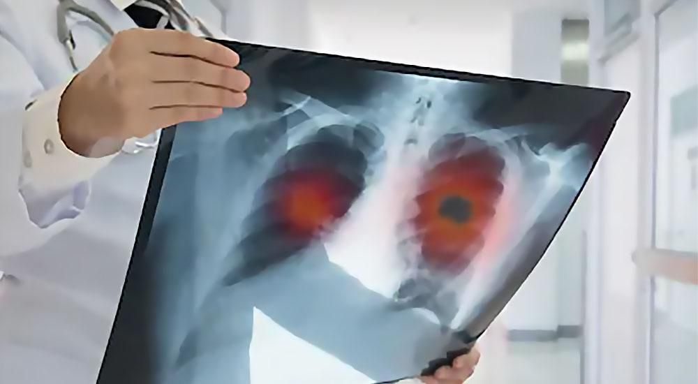 Ιός RSV : Τα συμπτώματα και πώς να τον αποφύγετε – Ποιοι κινδυνεύουν περισσότερο