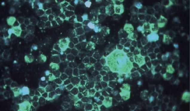 Ιός RSV : Τα συμπτώματα και πώς να τον αποφύγετε – Ποιοι κινδυνεύουν περισσότερο