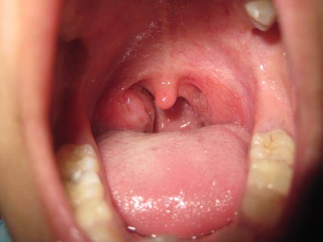 Μεγάλη προσοχή: Έξι παιδιά πέθαναν απο στρεπτόκοκκο Α – Ποια τα συμπτώματα