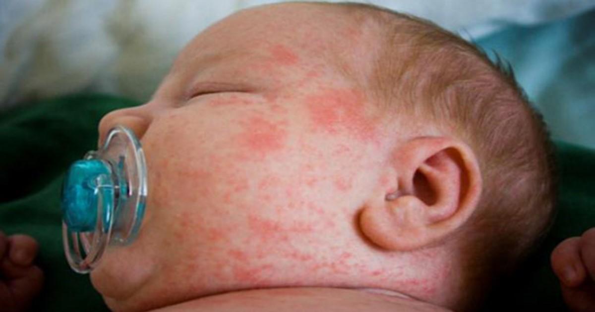 Μεγάλη προσοχή: Έξι παιδιά πέθαναν απο στρεπτόκοκκο Α – Ποια τα συμπτώματα