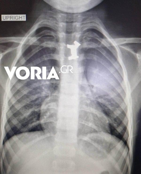 Θεσσαλονίκη : Παιδί 4,5 ετών κατάπιε μεταλλικό πιόνι