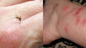 Αλλεργία στο τσίμπημα κουνουπιού:  Αυτά είναι τα ανησυχητικά συμπτώματα που πρέπει να σας κινητοποιήσουν