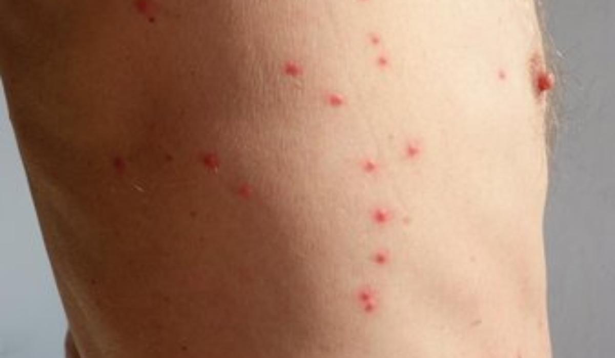 Τσιμπήματα απο έντομα στο κρεβάτι: Δείτε εικόνες και αναγνωρίστε τι σας τσίμπησε