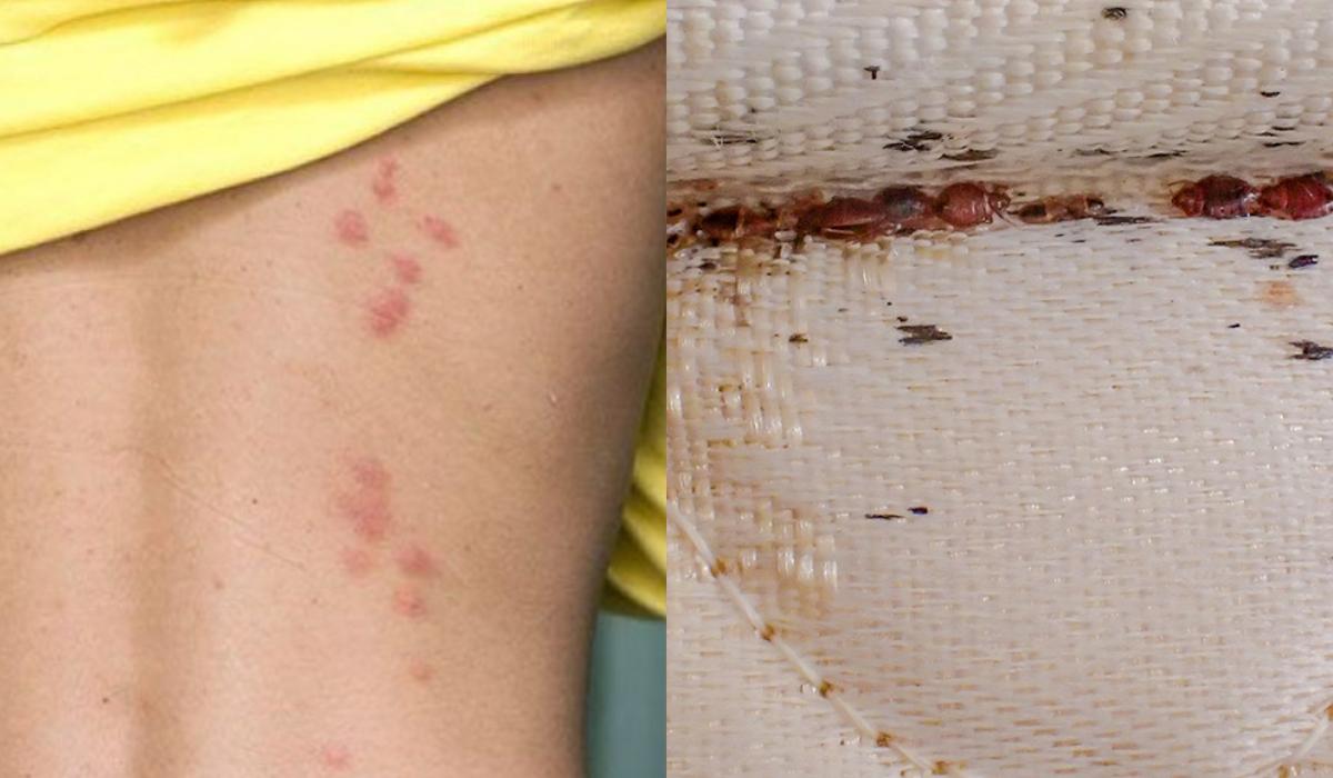 Τσιμπήματα απο έντομα στο κρεβάτι: Δείτε εικόνες και αναγνωρίστε τι σας τσίμπησε