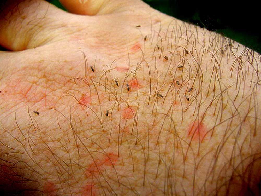 Τσιμπήματα απο έντομα στο κρεβάτι: Δείτε εικόνες και αναγνωρίστε τι σας τσίμπησε