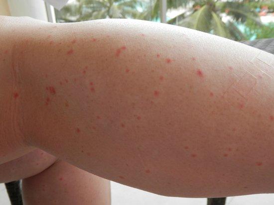 Τσιμπήματα απο έντομα στο κρεβάτι: Δείτε εικόνες και αναγνωρίστε τι σας τσίμπησε