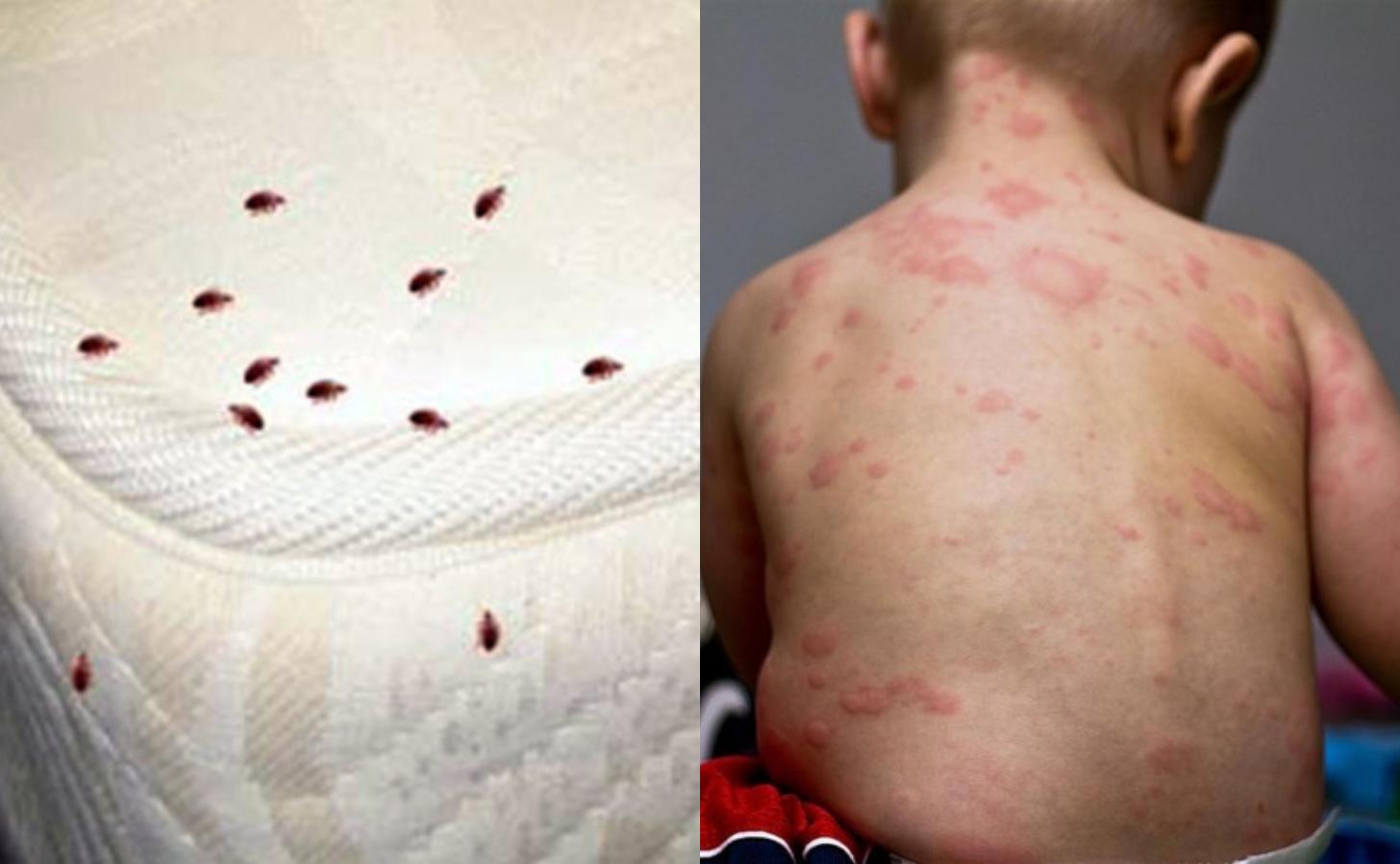 Τσιμπήματα απο έντομα στο κρεβάτι: Δείτε εικόνες και αναγνωρίστε τι σας τσίμπησε