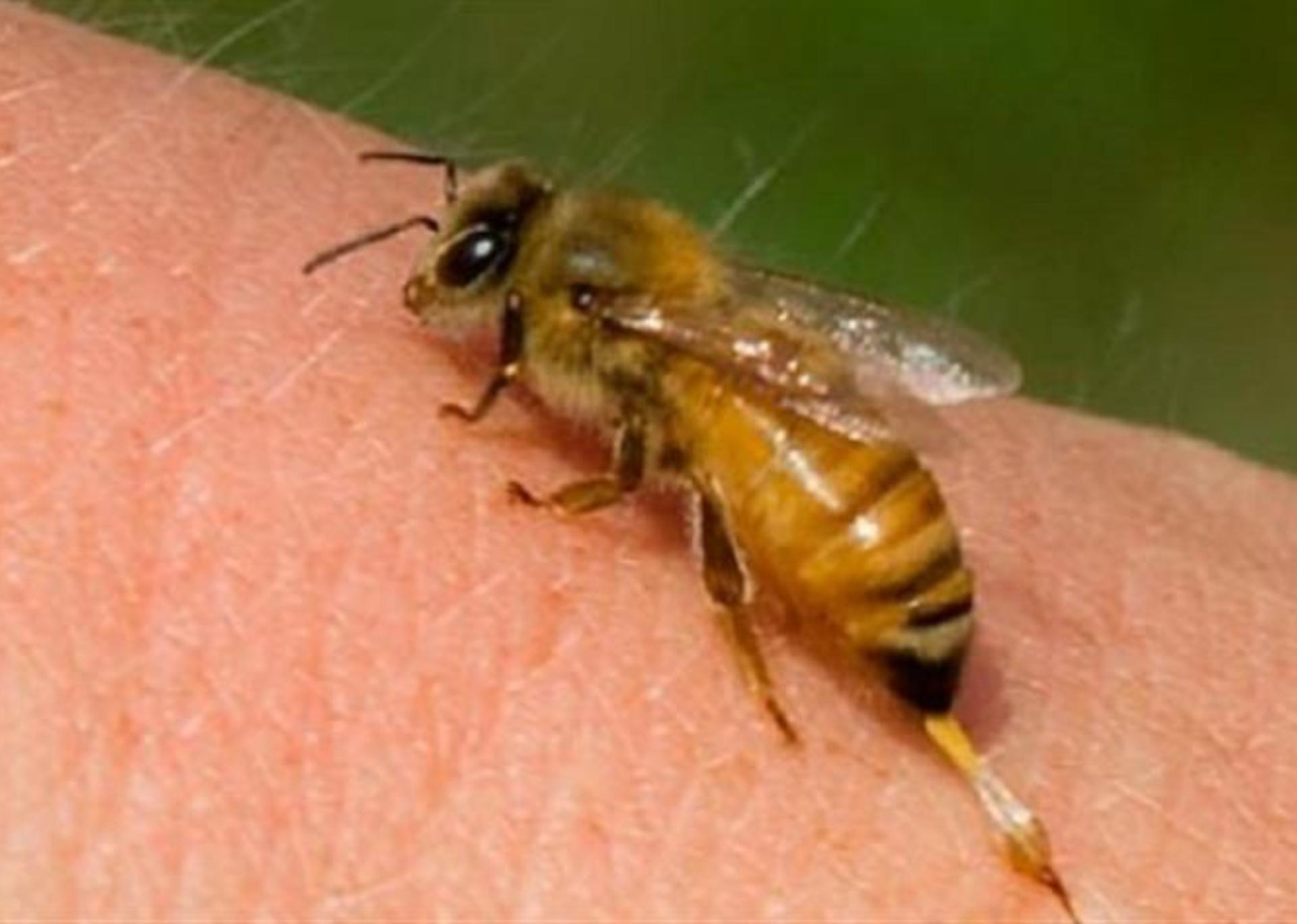 Τσίμπησε το παιδί μέλισσα ή σφήγκα; Τα συμπτώματα που δηλώνουν πως έπαθε αλλεργικό σοκ και πως να δράσετε