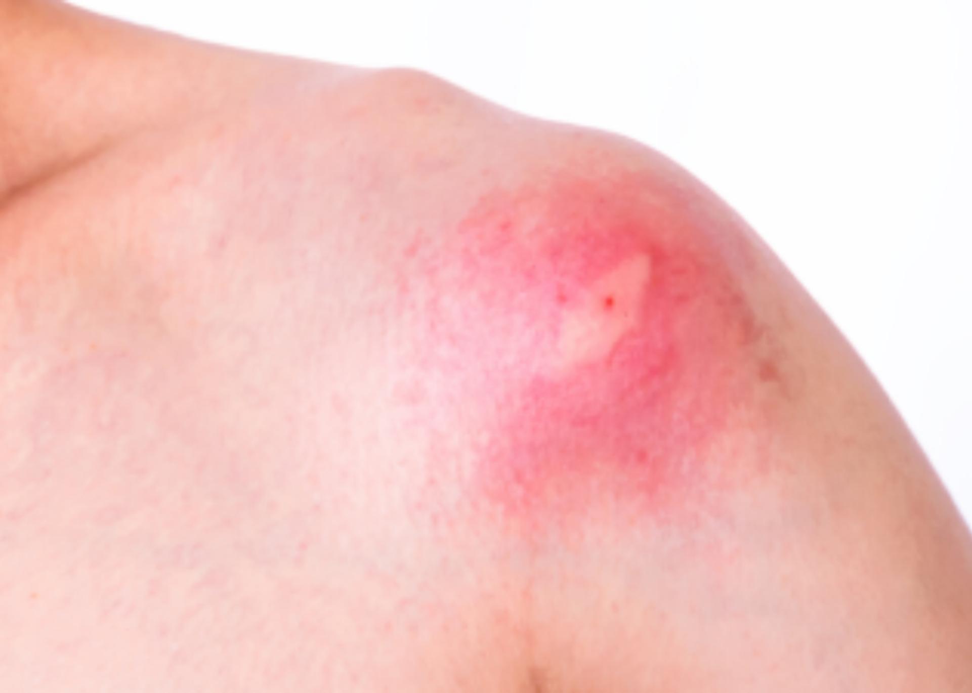 Τσίμπησε το παιδί μέλισσα ή σφήγκα; Τα συμπτώματα που δηλώνουν πως έπαθε αλλεργικό σοκ και πως να δράσετε